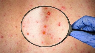 رجال فقط.. ألمانيا تسجل 11 إصابة جديدة بجدري القرود