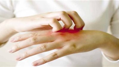 التشققات والجفاف في مقدمة أمراض البشرة بالشتاء، و3 نصائح لحماية جلدك