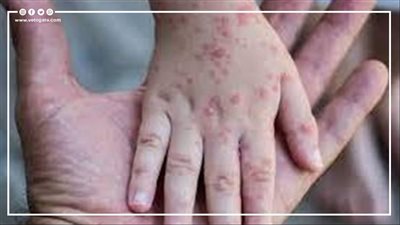 إجراءات الصحة لمنع دخول مرض فيروس جدري القرود مصر | إنفوجراف