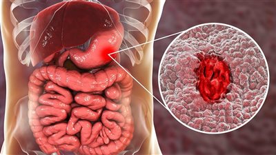 أعراض قرحة المعدة وأفضل نظام غذائي للعلاج والوقاية