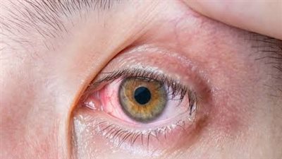 أعراض مرض الرمد الربيعي 