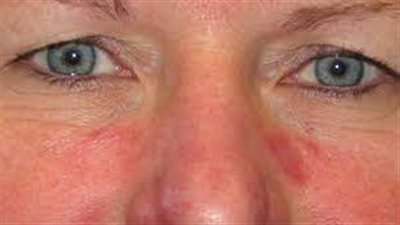 تعرف على علاج الذئبة الحمراء وأعراضها وأسباب الإصابة 