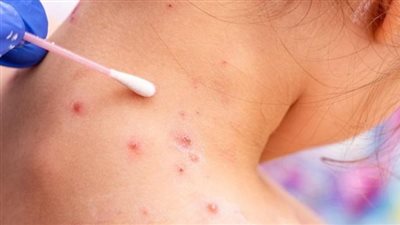 الإمارات تعلن تسجيل 5 إصابات بجدري القرود