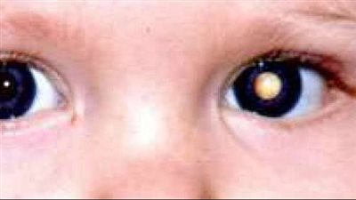 أسباب ظهور نقط بيضاء في عين حديثي الولادة 