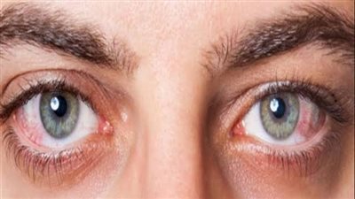 أهم أعراض الإصابة بإرهاق العينين وضرورة الكشف والعلاج