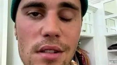 جاستن بيبر يعلن إصابته بشلل في الوجه | فيديو