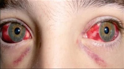 4 عوامل أدت إلى زيادة إصابات الحمى النزفية بالعراق.. أبرزها ذبح الحيوانات في الشوارع 