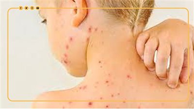 3 أمراض تسبب القرح والطفح الجلدي للأطفال.. أعرف الفرق بينها| فيديو جراف 