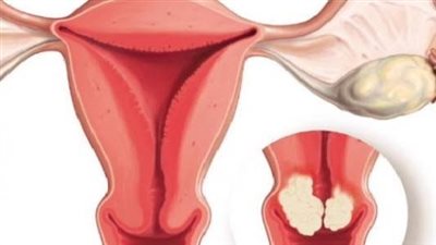 تحذير من استخدام أقراص منع الحمل لفترات طويلة: تسبب سرطان عنق الرحم 
