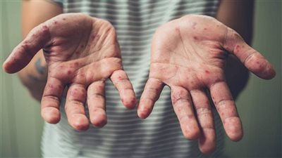 الصحة العالمية تبحث إعلان جدرى القردة 