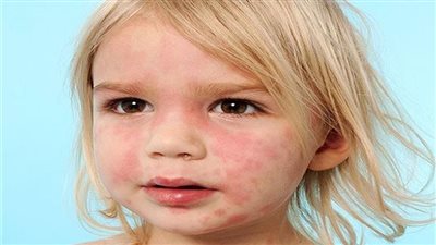 كيف تحمى طفلك من لدغات الحشرات فى الصيف.. استشارى يجيب