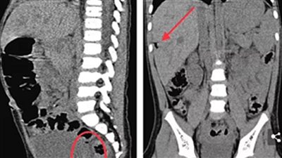 بسبب لعبة.. إصابة طفلة بثقب في الأمعاء وصديد في الكبد بألمانيا
