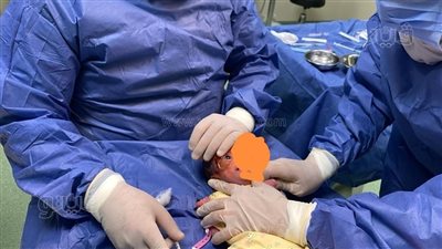 نجاح أول عملية حقن بالعين لتوأم يعاني من اعتلال بالشبكية بطنطا|صور