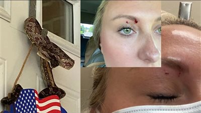 في حادثة نادرة.. ثعبان يلدغ سيدة في عينها