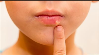 أوقفوا ظاهرة تقبيل الاطفال.. طبيبة تحذر من الهربس الفموي