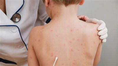 جدري القرود يظهر في دولة جديدة