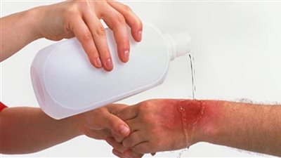  الإسعافات المنزلية لإصابات الحروق، ومتى يجب استشارة الطبيب؟