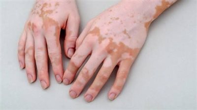 أعراض الإصابة بمرض البهاق وأسبابه