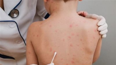 الصحة العالمية تبحث إعلان حالة الطوارئ بسبب جدري القرود 