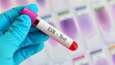 هل يمكن علاج سرعة الترسيب بحقنة البنسلين؟.. أخصائي يجيب