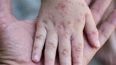 دولة أوروبية تسجل رقمًا كبيرًا بإصابات جدري القرود