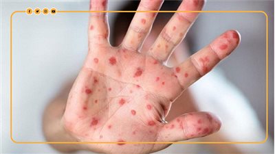 بعد تزايد الإصابات بجدري القرود.. هل يقترب العالم من جائحة جديدة؟ | فيديو جراف