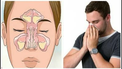 أهم اعراض الجيوب الانفية.. والعلاج بالزيوت العطرية 