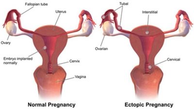اسباب التكيسات على المبيض | 