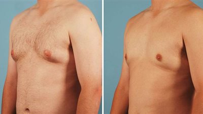 وائل غانم يكشف كيفية علاج التثدي عند الرجال