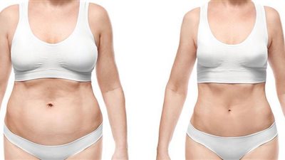 هل تفشل عمليات شفط الدهون ؟ وائل غانم يُجيب