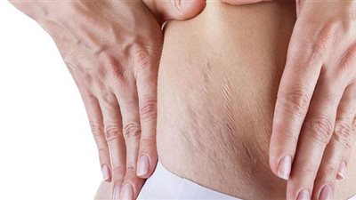 علاج السيلوليت | كيف يتم التخلص من العلامات المزعجة في الجلد؟ استشاري جراحة يُجيب