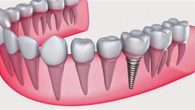 اعراض التهاب جذور الأسنان وطريقة علاجها