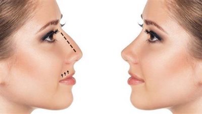 هل الفيلر يعالج مشاكل الأنف؟ استشاري تُجيب