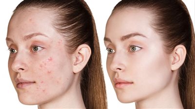 أسباب ظهور حبوب في الوجه.. وأفضل وأسرع علاج من الطبيعة