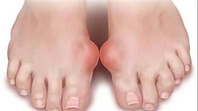 أعراض مرض النقرس وعوامل تزيد من نسب الإصابة به