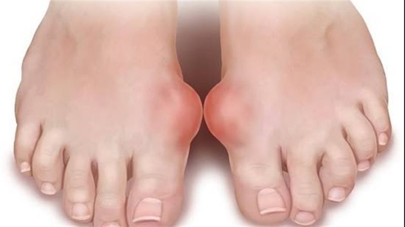 مرض النقرس