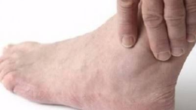 8 نصائح للوقاية من نوبات مرض النقرس 