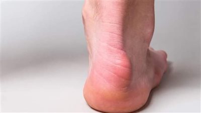 تسببه أحذية الكعب العالي.. كل ما تريد معرفته عن متلازمة هاجلوند