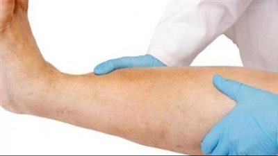 أعراض انسداد شرايين الساقين وطرق العلاج