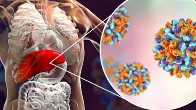 ارتفاع حصيلة مصابي التهاب الكبد الغامض لدى الأطفال على مستوى العالم 