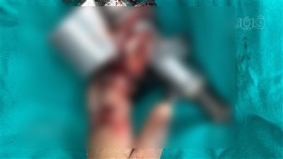 يدها داخل مفرمة لحوم.. فريق طبي بطنطا ينجح في إنقاذ طفلة | صور