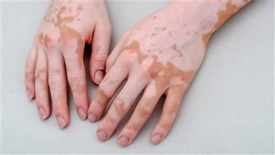 بـ 30 ألف جنيه.. هاني الناظر يصدم الجميع بسعر العلاج الجديد للبهاق | فيديو