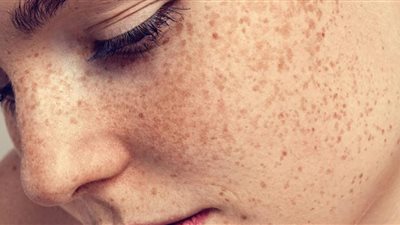 أسباب تصبغات الوجه وطرق العلاج الحديثة