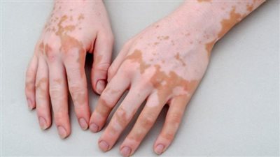 تقنيات علاج البهاق في مصر وتكلفتها.. الدواء الجديد سعره 70 ألف جنيه.. و1500 دولار تكلفة العلاج الضوئي بالليزر