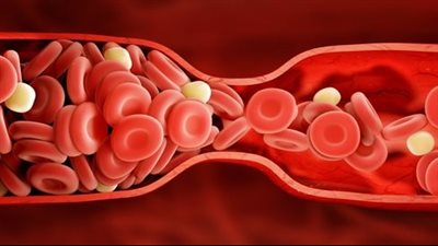 نصائح هامة لتجنب الجلطات فى فصل الصيف | فيديو