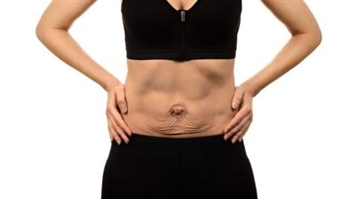أسباب ترهلات البطن بعد الولادة وطرق التخلص منها