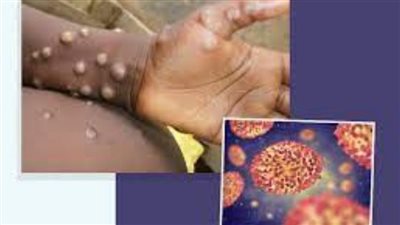  أعراض فيروس جدري القرود