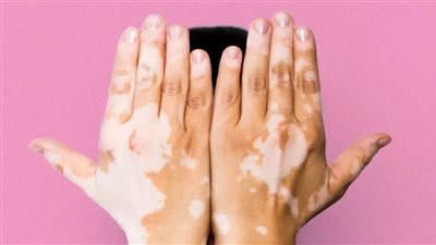  6 معلومات عن أشهر كريم لعلاج البهاق في العالم