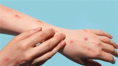 الصحة توضح حقيقة ظهور فيروس جدري القرود في مصر
