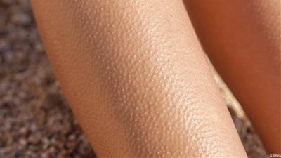 تعرفي على علاج جلد الوزة.. وأسباب الإصابة 